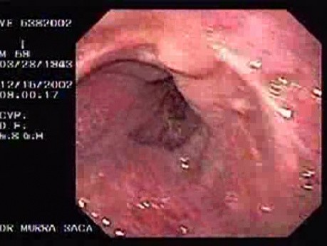 Schatzki Ring - a 59 Years Old, Symptomatic Patient