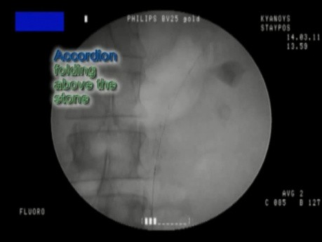 Stone Management Device - Fluoroscopy