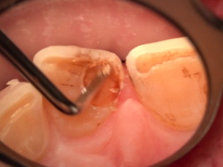 Laser Technology in Conservative Dentistry