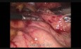 Lap Gastric Sleeve Resection for GIST