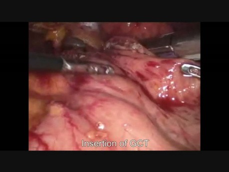 Lap Gastric Sleeve Resection for GIST