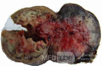Jejunal Gastrointestinal Stromal tumor (GIST) (7 of 86)