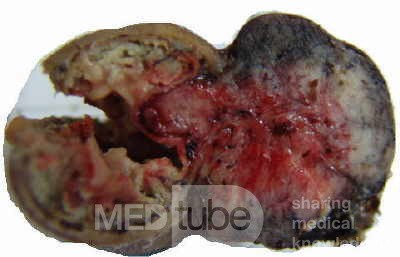 Jejunal Gastrointestinal Stromal tumor (GIST) (7 of 86)