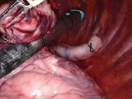 Robot-assisted Lung Wedge Resection of Mass