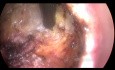 TransAnal Total Mesorectal Excision for the Distal Rectal Cancer