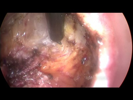 TransAnal Total Mesorectal Excision for the Distal Rectal Cancer