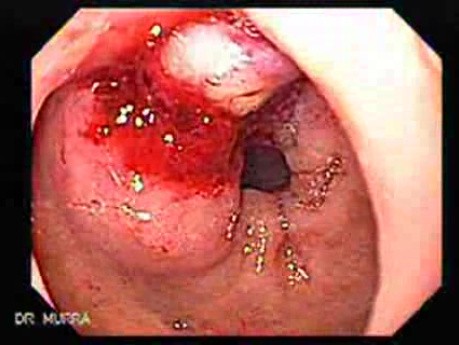 Duodenal Ulcer and Bleeding (11 of 23)