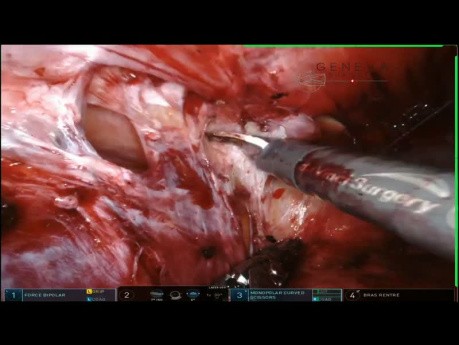 Modified Pauli's Ileal Conduit Parastomal Hernia Repair