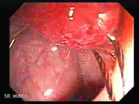 Malign Polyp (2 of 2)