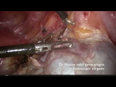 Challenging Adnexectomy for Complex Ovarian Mass