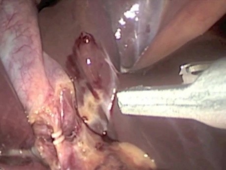 SILS of a gallbladder