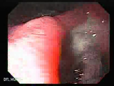 Gastric Cicatrization With Pylorus Stenosis (11 of 23)