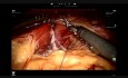 Robotic Sleeve Gastrectomy