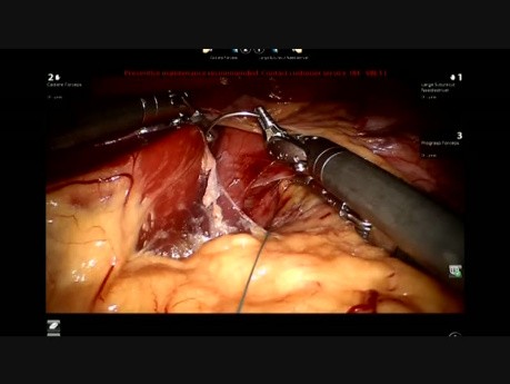 Robotic Sleeve Gastrectomy