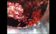 Robot Assisted Retroperitoneal, Pelvic and Inguinal Lymphadenectomy