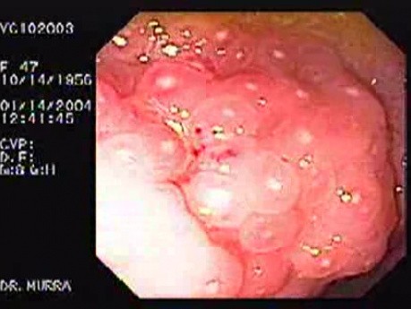 Amebic Colitis