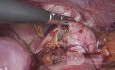 Ulcer Perforation in the Remaining Stomach years after Sigle's Anastomosis Gastric Bypass Bariatric Surgery