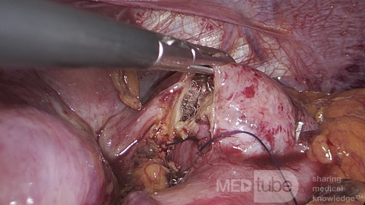 Ulcer Perforation in the Remaining Stomach years after Sigle's Anastomosis Gastric Bypass Bariatric Surgery