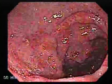 Gastric Antral Vascular Ectasias - GAVE (2 of 6)
