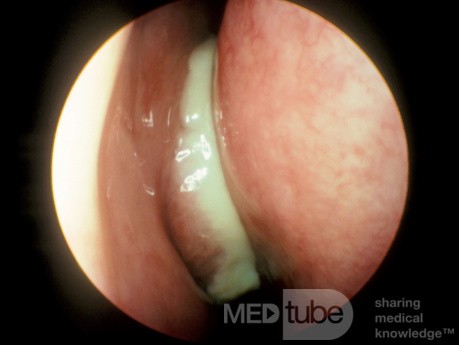 Acute Maxillary Sinusitis [before treatment]