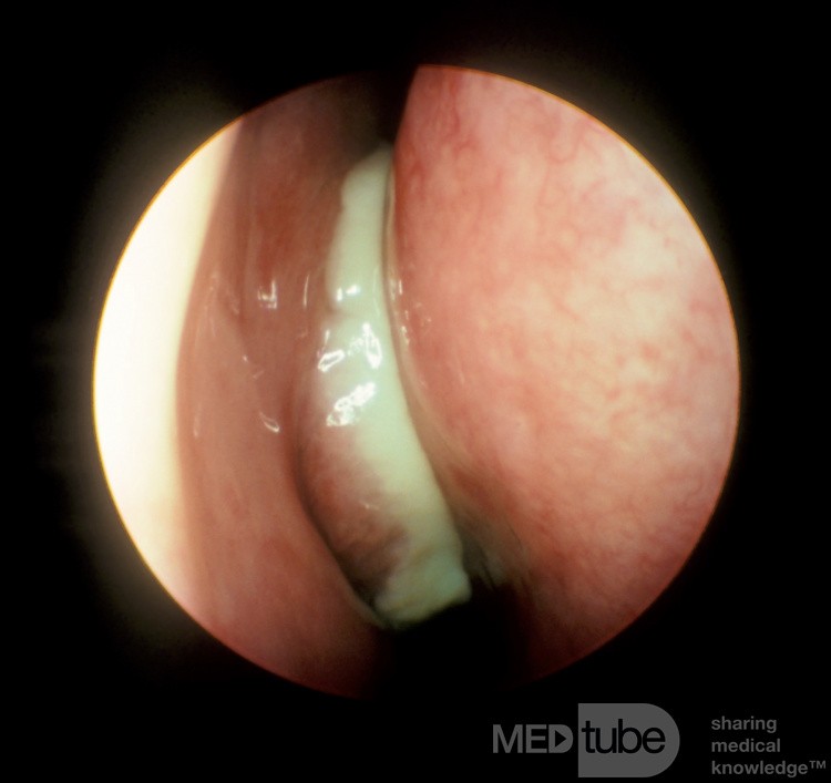 Acute Maxillary Sinusitis [before treatment]