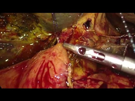 Laparoscopic Double Bypass in Unresectable Pancreatic Cancer