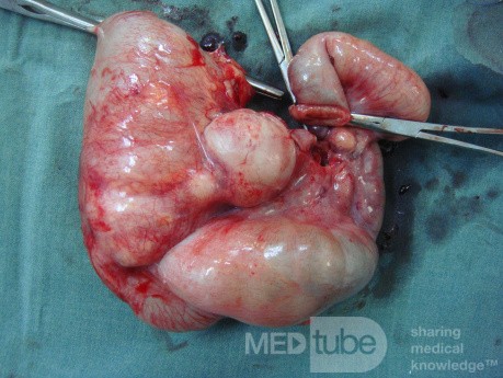 Intussusception, non Hodgkin's lymphoma - right hemicolectomy
