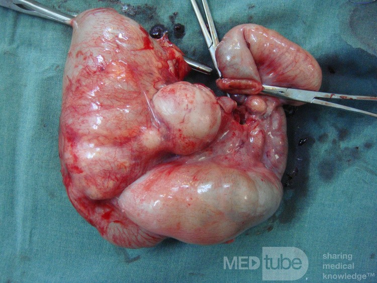 Intussusception, non Hodgkin's lymphoma - right hemicolectomy