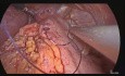 Migrating Gastric Band