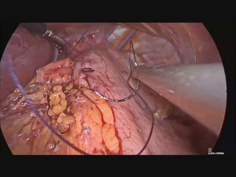 Migrating Gastric Band