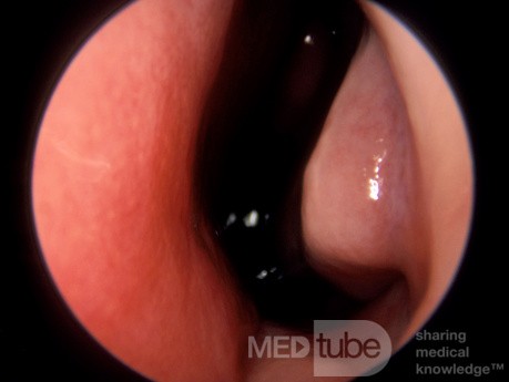 Anterior Nasal Mucosal Changes Secondary to Total Nasopharyngeal Airway Obstruction from Enlarged Adenoids