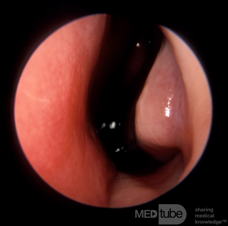 Anterior Nasal Mucosal Changes Secondary to Total Nasopharyngeal Airway Obstruction from Enlarged Adenoids