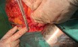Whipple Procedure