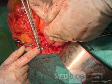 Whipple Procedure