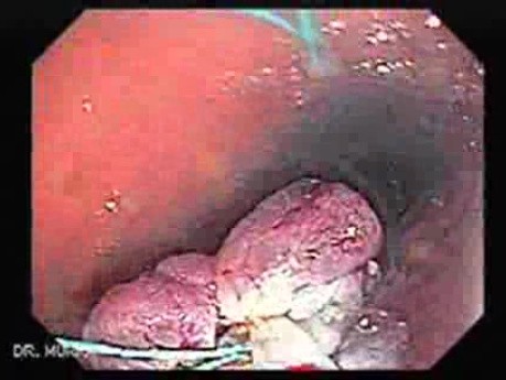 Huge Mass Of The Descending Colon (16 of 25)
