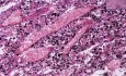 Histopathology Lymph node--Anthracosis, tuberculosis