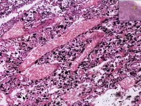 Histopathology Lymph node--Anthracosis, tuberculosis