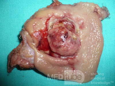 Gastrointestinal Stromal tumor (GIST) (53 of 65)