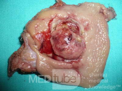 Gastrointestinal Stromal tumor (GIST) (53 of 65)