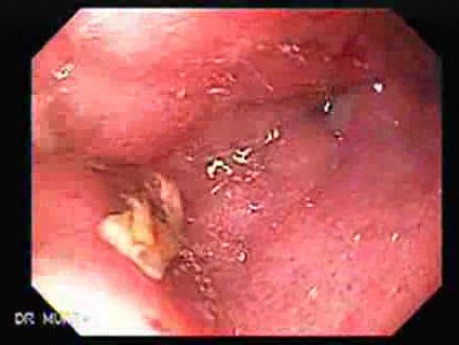 Gastric Lymphoma with Metastases to the Duodenum - Extensive Infiltration of the Antrum