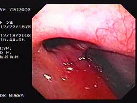 Flexible Endoscopic Suturing - Placement of Ti-Knot Device