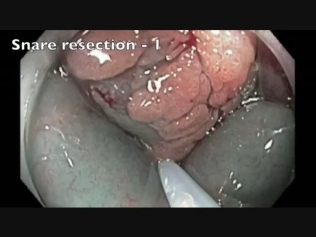 Colon EMR Perforation Analysis-D