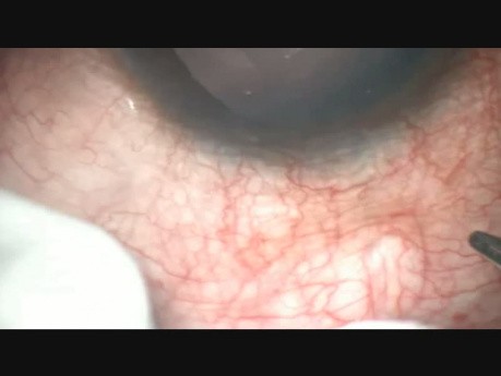 Angle Recession Glaucoma with Traumatic Mydriasis, Microtrack Filtration