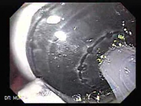 Intragastric Balloon - The Treatment Of Obesity (7 of 13)