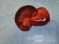 Obstructive Ileus - Right Colon Flexure Cancer