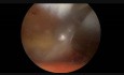 Biportal Endoscopic Discectomy Rt
