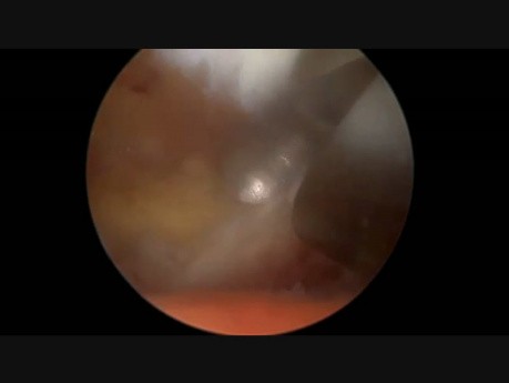 Biportal Endoscopic Discectomy Rt