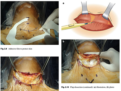 Atlas of Thyroid Surgery - Open, Endoscopic and Robotic Procedures