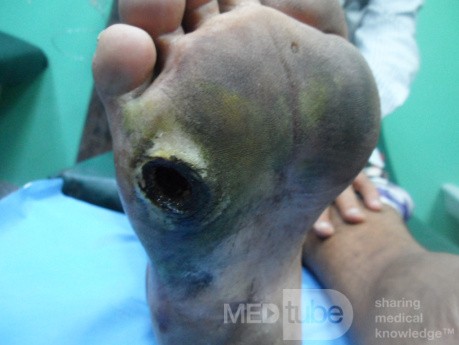 Diabetic Foot Ulcer - Neuropathic - Filled With Herbal Material