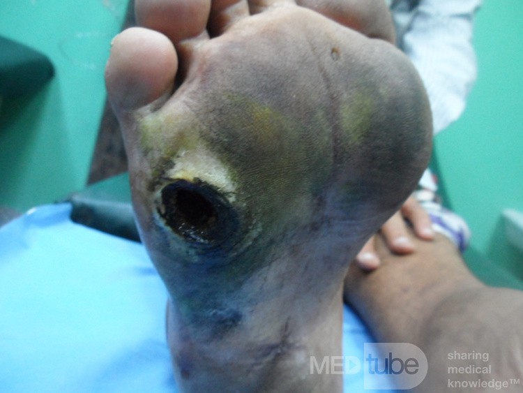 Diabetic Foot Ulcer - Neuropathic - Filled With Herbal Material
